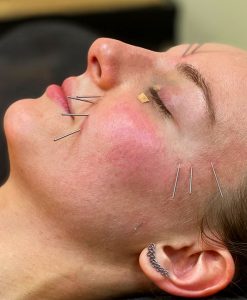 curso acupuntura facial
